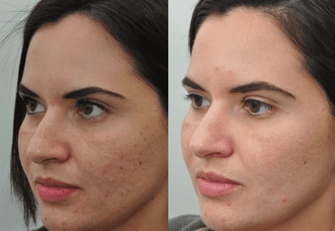 Getting rid of female facial hair