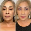 Kybella-before-after-1