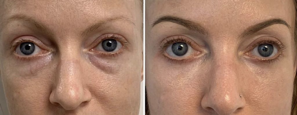 bags-under-eyes-treatment-package