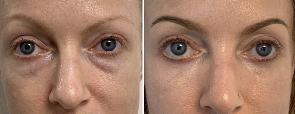 Reason And Treatment For Bags Under Eyes
