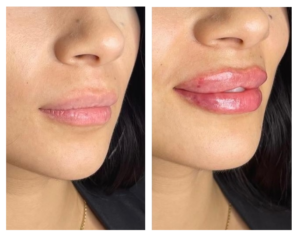 Juvederm-Volbella-Lip-Filler-phoenix