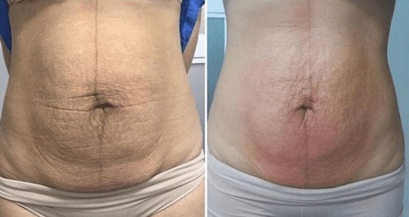 How to Tighten Loose Skin Without Surgery, Stomach