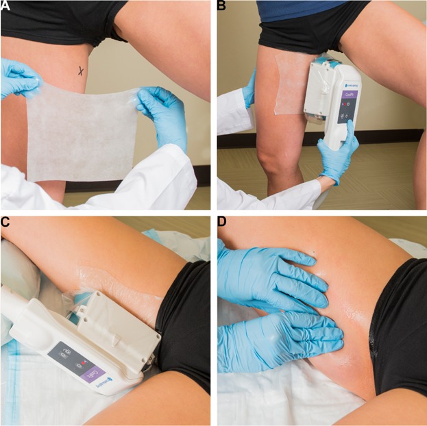 CoolSculpting Cryolipolysis For Safe And Effective Inner Thigh Fat 