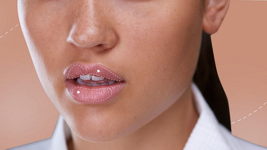 What Not to Do After a Lip Filler Injection?
