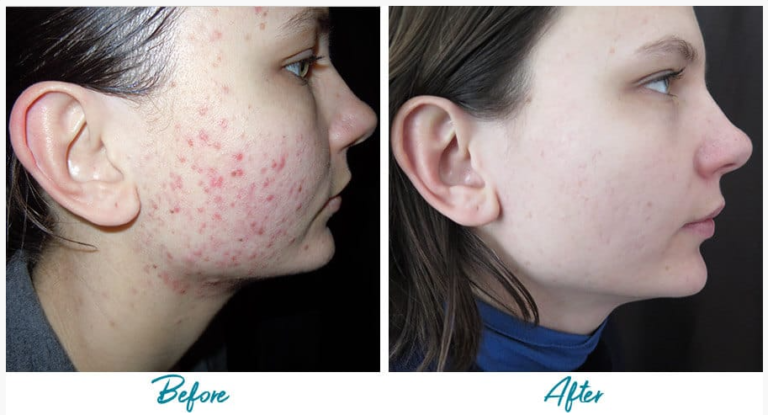 the-only-9-acne-scar-removal-treatments-that-work