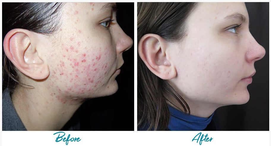 Acne Scar Treatments PHX Acne Suddenly Slimmer Med Spa Phoenix