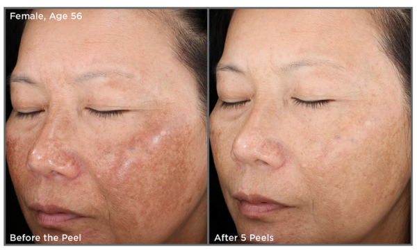 Vitalize Peel PHX I Skin Medica Peel Near Me Phoenix