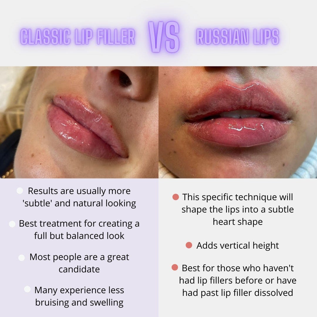 Classic lip filler vs Russian lips | Suddenly Slimmer Med Spa