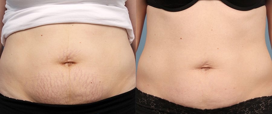 How to Get Rid of Cellulite and Stretch Marks? - Alite Laser