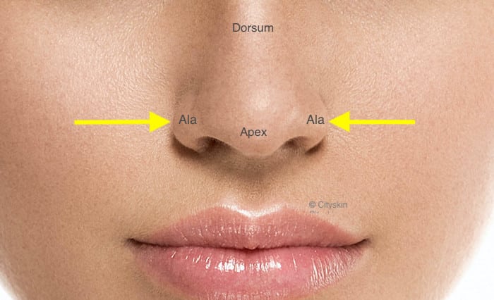 Botox for slimming wide nose