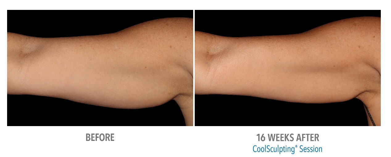 Coolsculpting-before-and-after-arms-phoenix