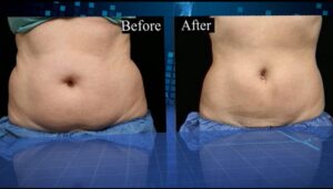 Coolsculpting-elite-phoenix-arizona-2