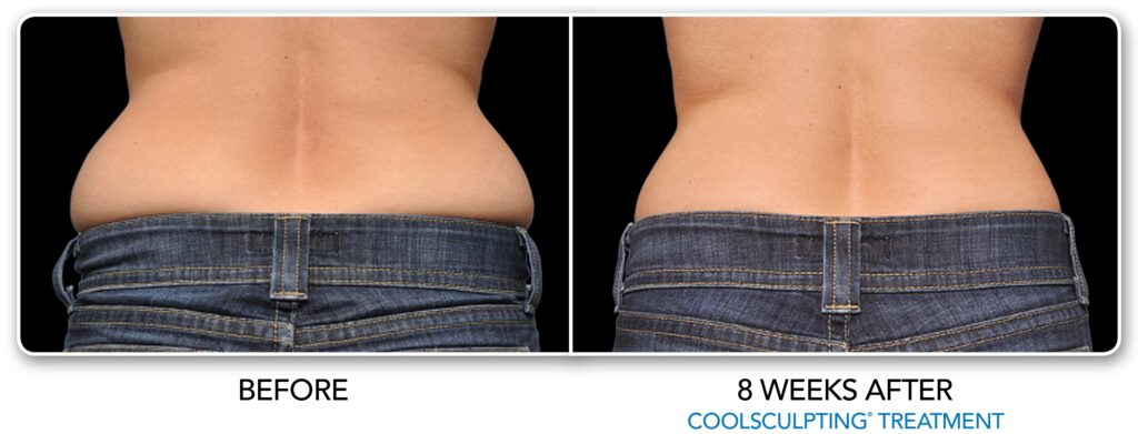 CoolSculpting Love Handles - Treatment of Love Handles in Phoenix