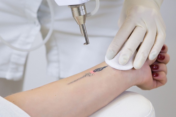 Tattoo-removal-Phoenix-Arizona