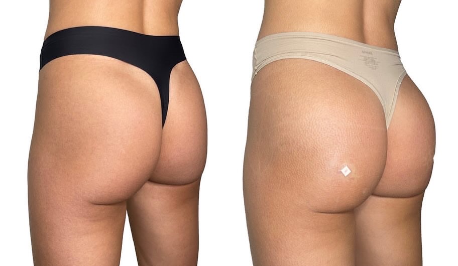 Before & After Non-Surgical Butt Injection by Dannielli RN  | Awarded Top BBL Provider in Arizona! 